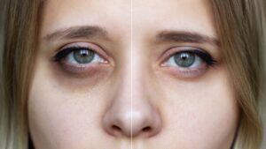 Dark Circles