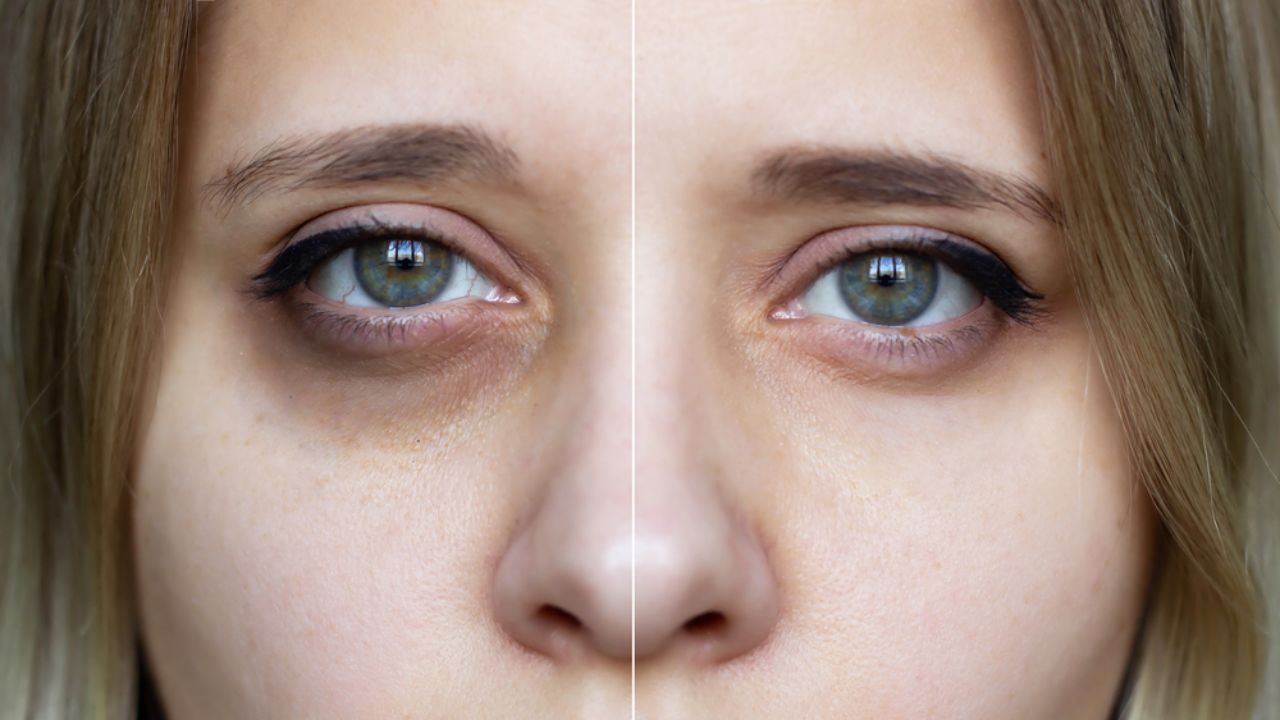 Dark Circles