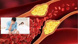 High Cholesterol