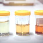 Urine infection: యూరిన్ ఈ కలర్‌లో వస్తుందా?.. తస్మత్ జాగ్రత్త!