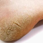 Cracked Heel Remedies: వావ్ ఇట్స్ అమేజింగ్.. పగిలిన మడమల కోసం చక్కటి చిట్కాలు!