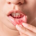 mouth ulcers Causes: నోటిపూతకు ఇవే అసలైన కారణాలు.. వెంటనే తెలుసుకోండి!