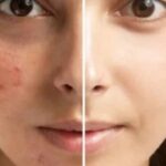 Skin Care Tips: ముఖంపై మొటిమలకు ఈజీ టిప్స్.. వావ్ ఇట్స్ అమేజింగ్!