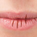 lips Causes: లిప్స్ పగిలిపోవడం.. నల్లగా మారడానికి కారణాలు ఇవే.. ఈ టిప్స్‌తో కంట్రోల్ చేసేయండి!