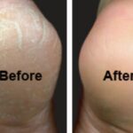 cracked heels tips: పగిలిన మడమల వల్ల ఇబ్బంది పడుతున్నారా?.. బెస్ట్ ఇంటి చిట్కాలు ఇవే!