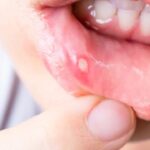 Mouth ulcers: ఇంటి చిట్కాలతో నోటి పూత సమస్యను ఇలా తగ్గించుకోవచ్చు.. మందులు అవసరమే లేదు!
