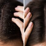 Hair Dandruff Home Tips: వర్షాకాలంలో విపరీతమైన చుండ్రు సమస్య.. ఇంటి చిట్కాలతో తరిమేయండి!