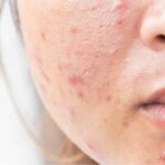 face pimples remove tips: ముఖంపై మొటిమలతో బయటకు రాలేకపోతున్నాారా?.. ఇలా చేస్తే బాగా తగ్గుతాయి!